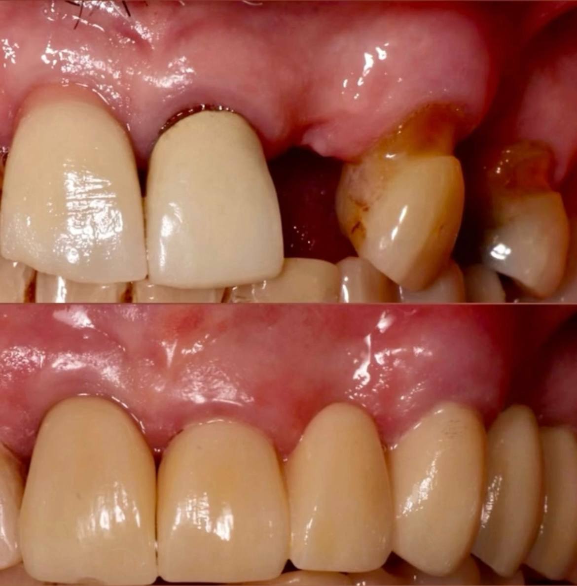 Antes y Después - Caso 5
